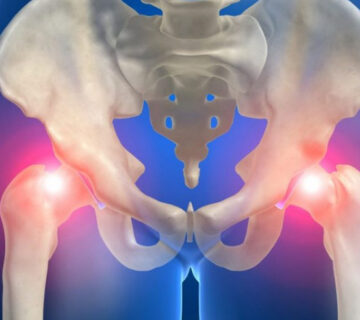 آرتروز-_-لگن