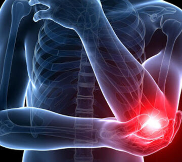 آرتروز-مفصل-آرنج