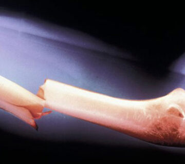 شکستگی-بازو