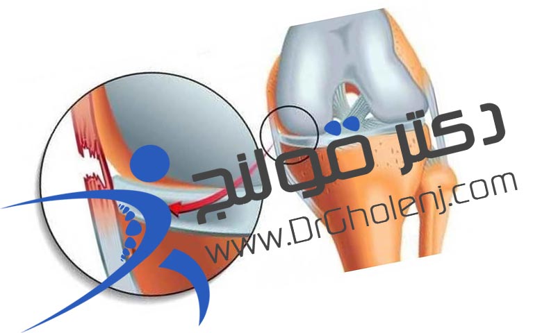 مینیسک زانو دکتر قولنج