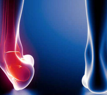 پیچیدن مچ پا