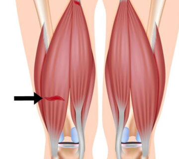 کشیدگی-همسترینگ