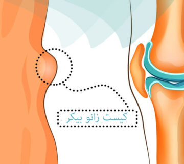 کیست-زانو-بیکر