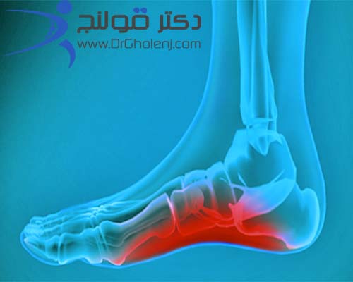 فیزیوتراپی دراصفهان | دکتر قولنج | درد کف پا: علت و درمان و تشخیص درد کف پا