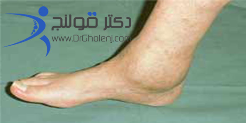 آرتروز مچ پا دکتر قولنج