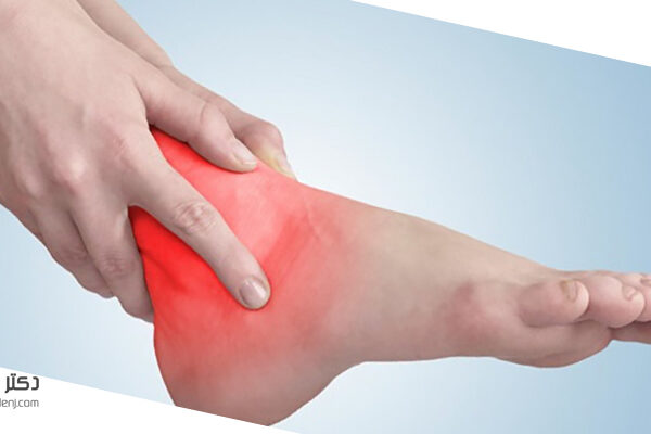 آرتروز مچ پا