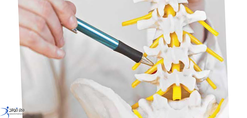 تنگی کانال نخاع