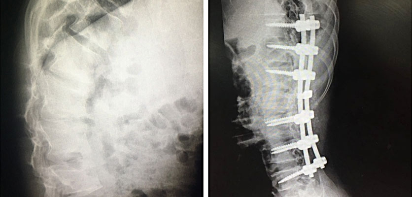 بهترین فیزیوتراپی در اصفهان | فیزیوتراپی تنگی کانال نخاعی در اصفهان