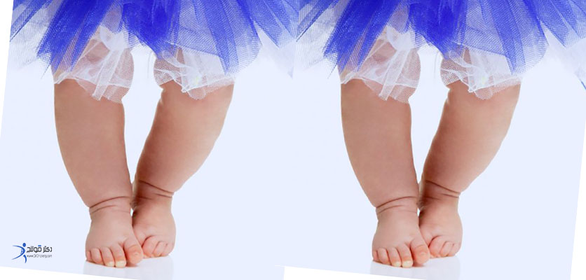 زانوی پرانتزی