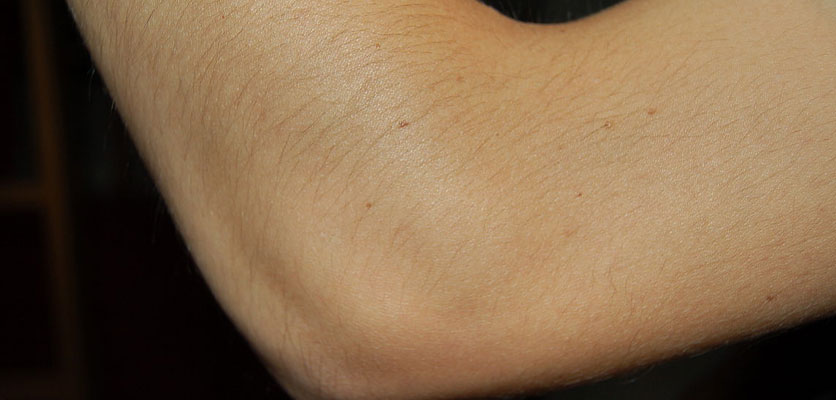 بهترین فیزیوتراپی دراصفهان | فیزیوتراپی آرتروز آرنج دراصفهان