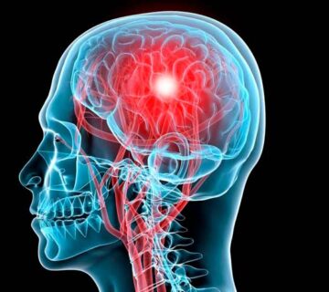 انوریسم-مغزی