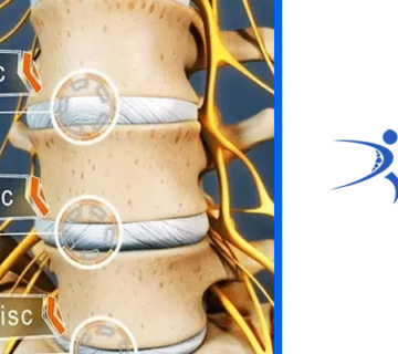 فتق ديسک کمر