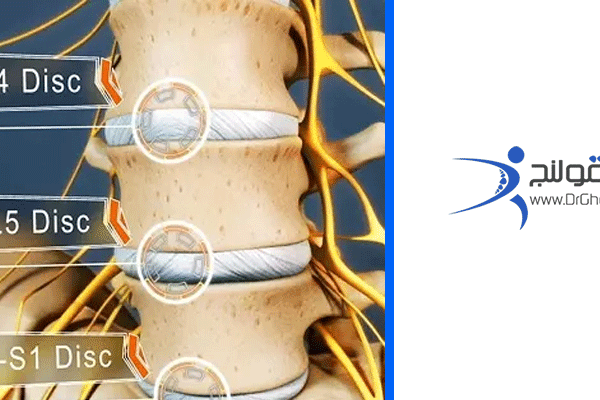 فتق ديسک کمر