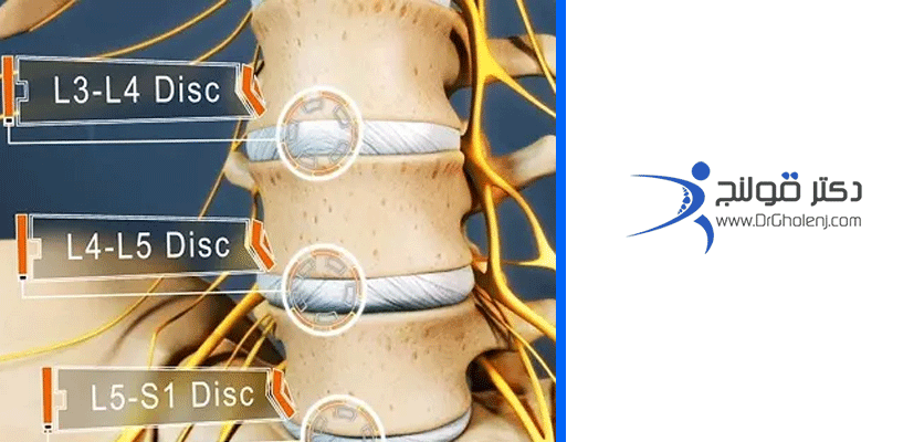 فتق ديسک کمر